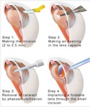 What-does-cataract-surgery-entail--